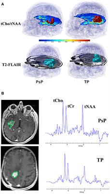 Emerging MR Imaging and Spectroscopic Methods to Study Brain Tumor Metabolism